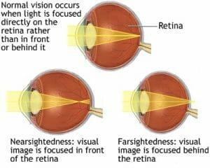 Nearsighted vs. Farsighted