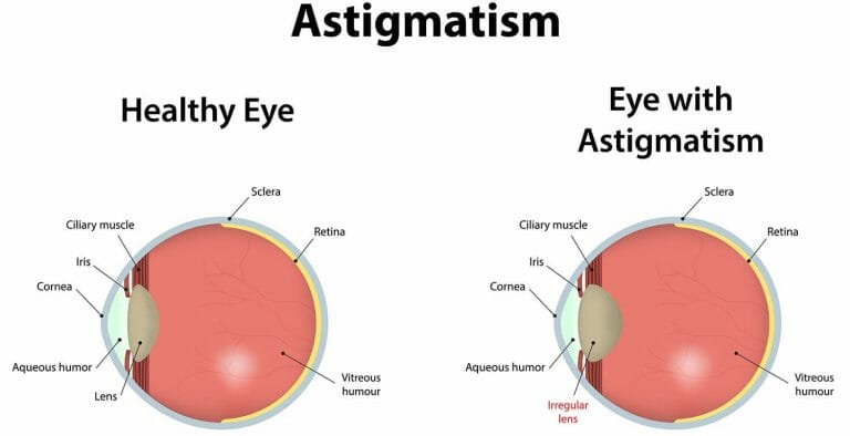 Astigmatism and its correction lenses | Blog - Buy Contact Lenses in pakistan @ lenspk.com