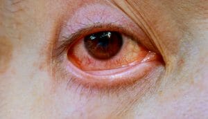 13 Health problem signs your eyes could be showing