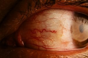 13 natural remedies to relieve dry eyes