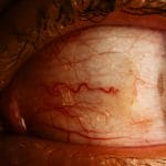 13 natural remedies to relieve dry eyes