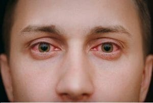 What's the difference between pink eye and allergies
