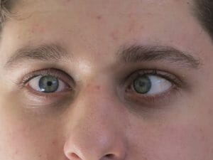 A cross eyed person
