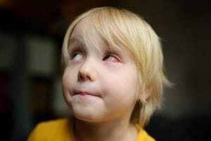 eye irritation